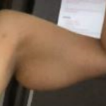 female arm before bodytite technology