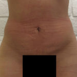 female abdomen after bodytite technology by Dr. Kenneth Hughes