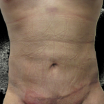 male abdomen after bodytite technology Dr. Kenneth Hughes