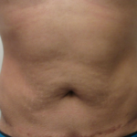male abdomen before bodytite technology