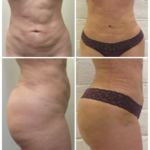 female abdomen before and after bodytite technology